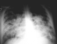 The chest roentgenogram typically shows diffuse bilateral infiltrates. Source: The Internet Journal of Emergency and Intensive Care Medicine TM 