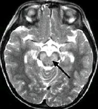 MRI findings in Enterovirus Encephalitis