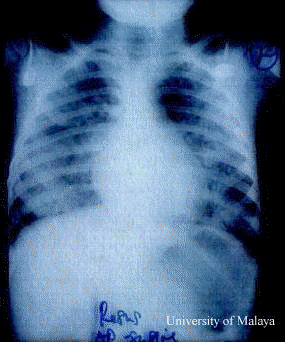 Neurogenic Pulmonary Edema