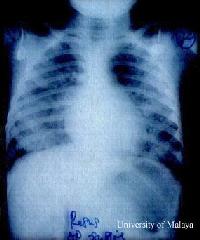 Neurogenic pulmonary edema