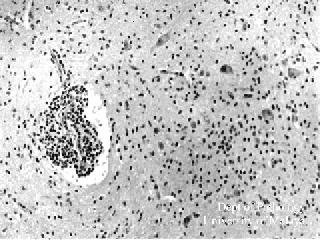 Figure 1 : Medulla: Perivascular inflammation and inflammatory cells in the parenchyma. Click on picture for larger picture.