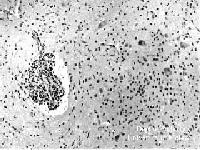 Pathological Findings