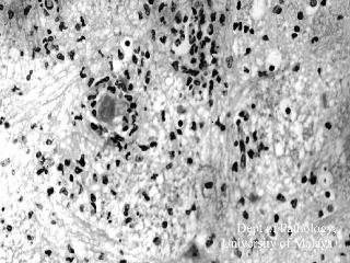 Figure 2: Medulla: Intense inflammation with oedema, microglial nodule formation, and phagocytosis. Some neutrophils are also noted. Click on image to see larger picture.