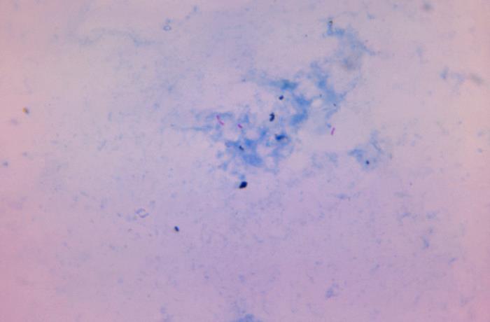 Photomicrograph of a Ziehl-Neelsen stained smear: a few rod-shaped acid-fast bacilli stained magenta against a blue background.